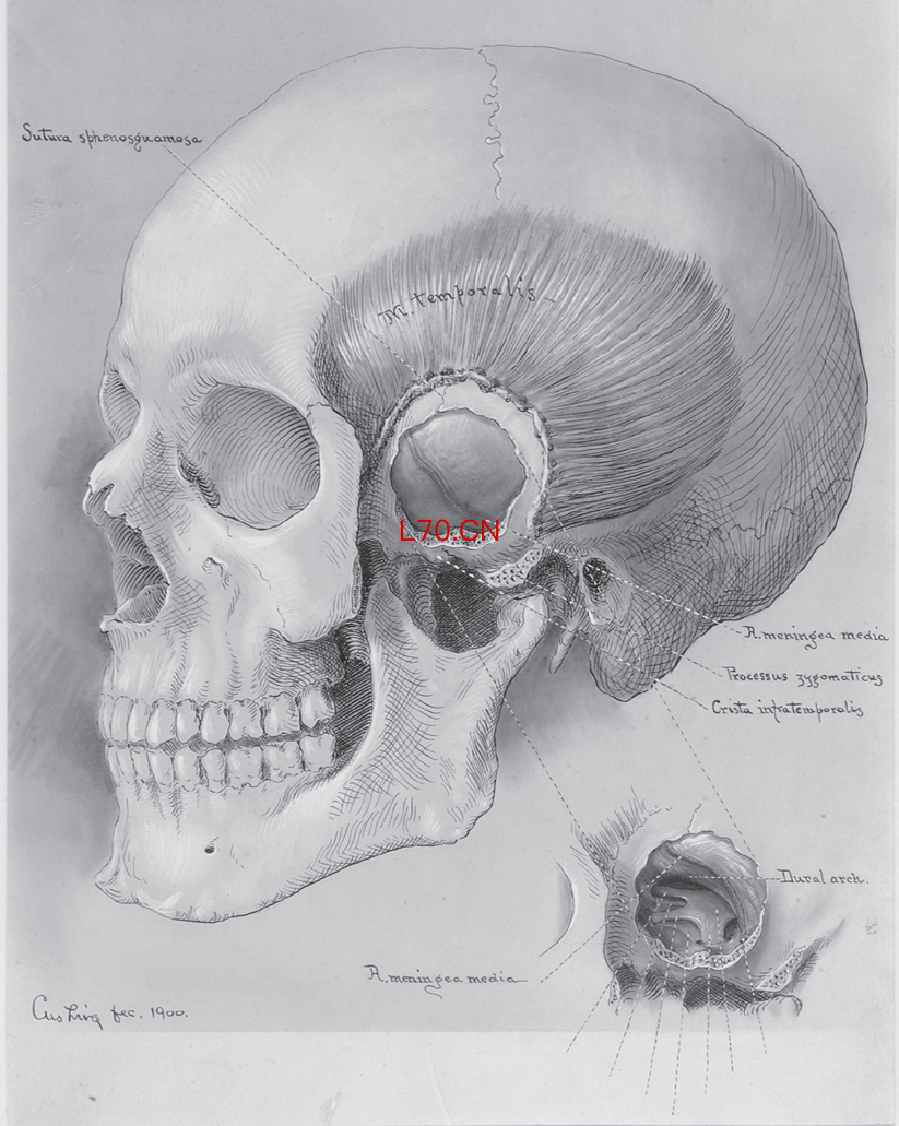 库欣的素描作品，来自他的一台手术（耶鲁大学哈维·库欣约翰·海伊·惠特尼医学图书馆的医学史资料室）   出版社供图